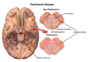 Best Doctor for Parkinson Disease in Bangalore